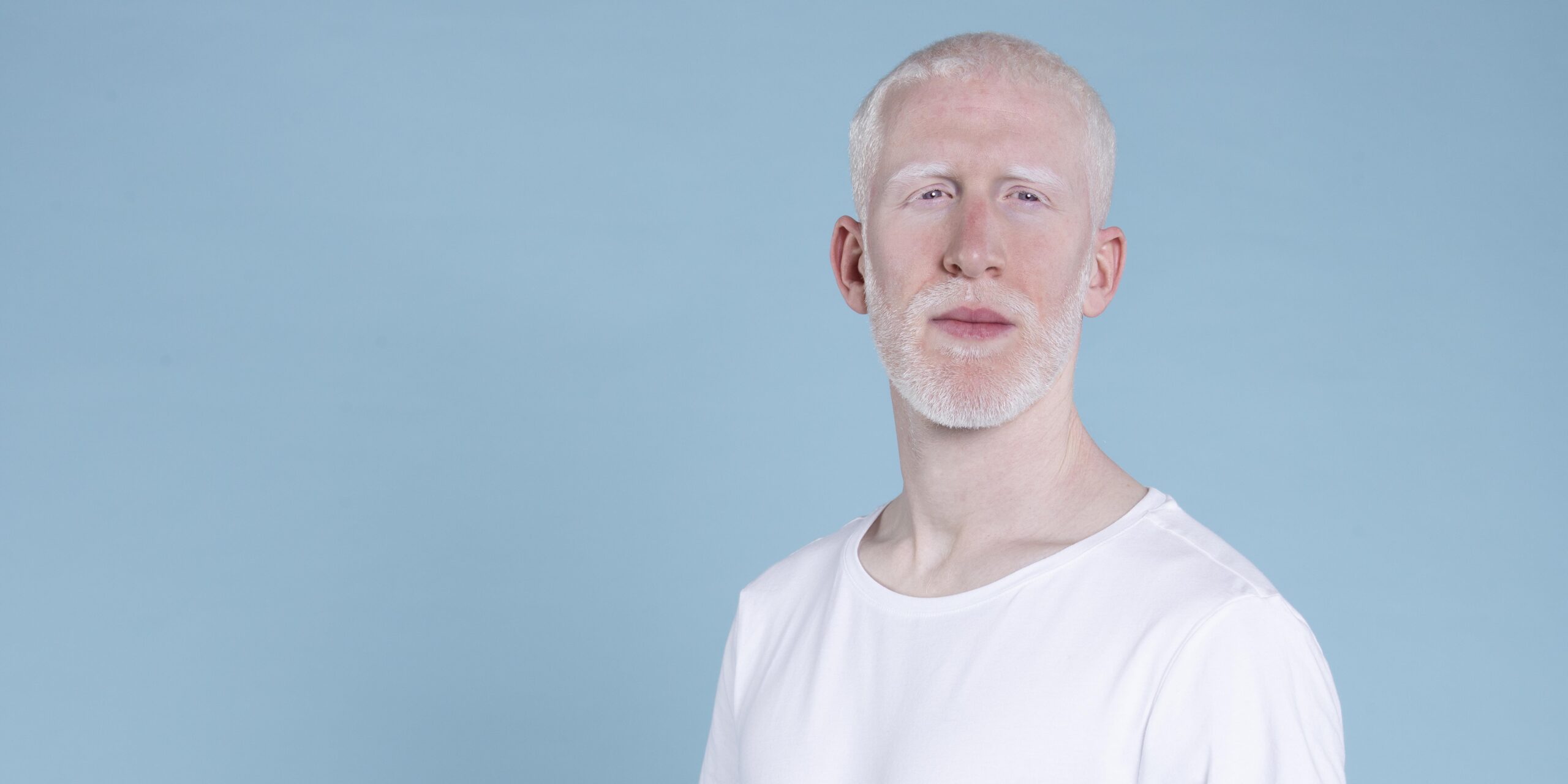 Lula sanciona política de proteção às pessoas com albinismo